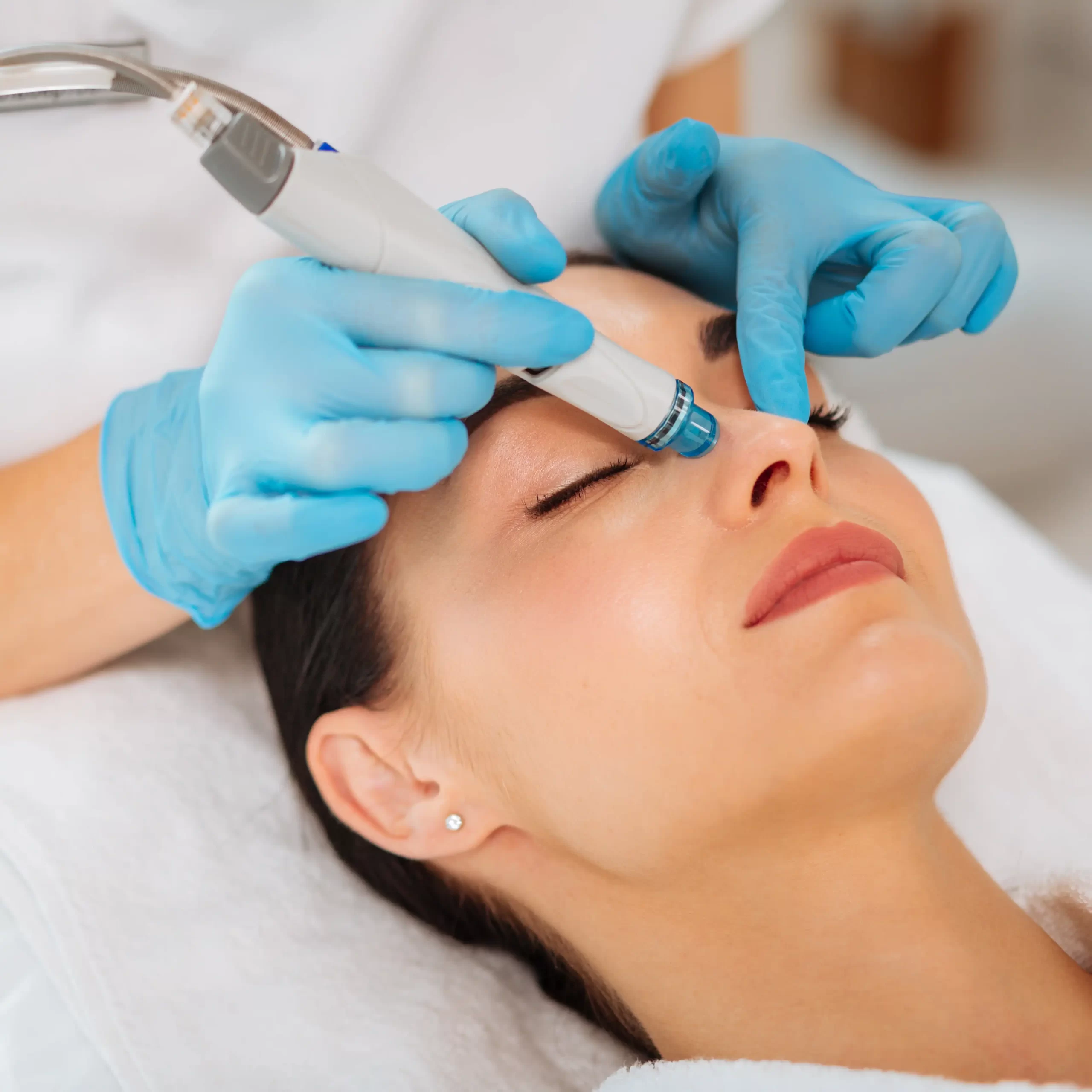 abq-acne-hydrafacial-feature