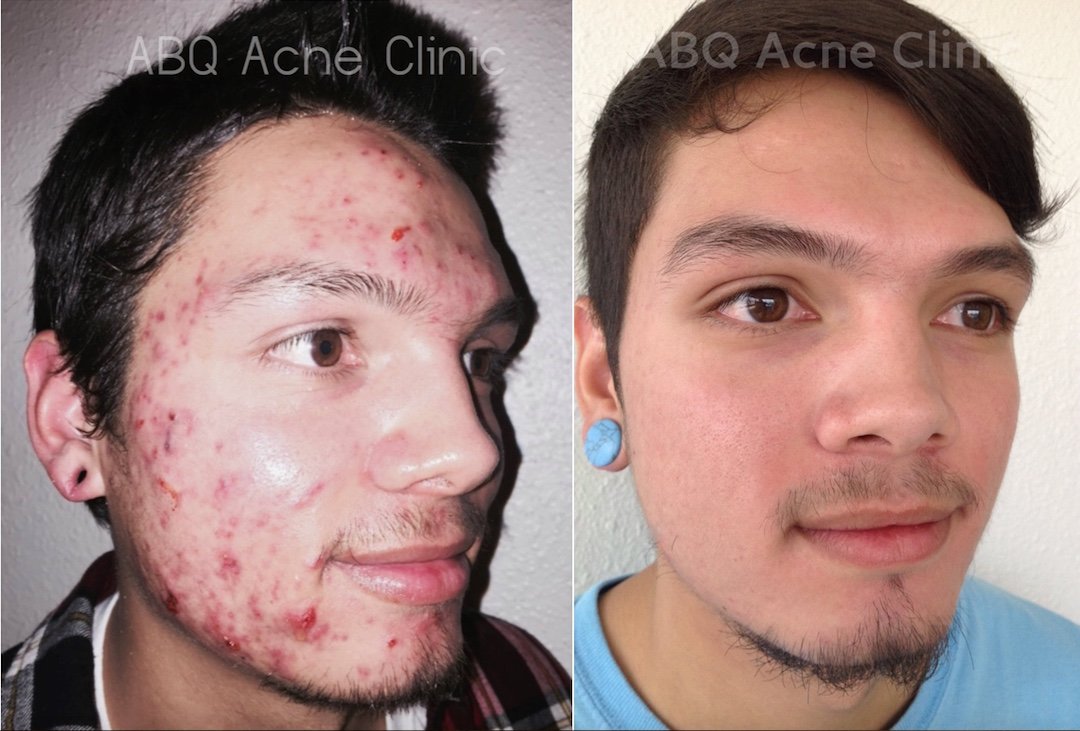 Home Best Facials Albuquerque Has To Offer ABQ Skin Care & Acne Clinic